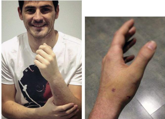 A Casillas ya le quitaron el yeso (Foto)