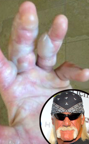 Hulk Hogan se achicharró una mano (Foto)