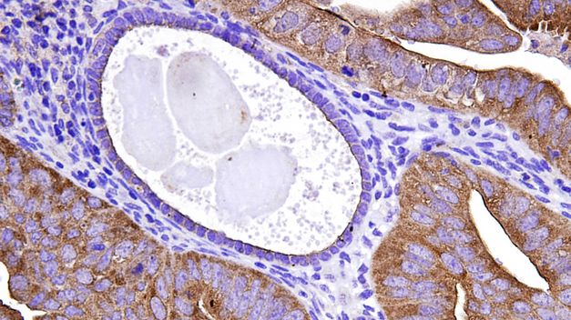 Adelantarse a la metástasis, el reto de la investigación científica