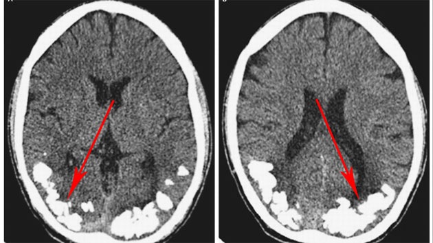 Hallan piedras en el cerebro de un brasileño