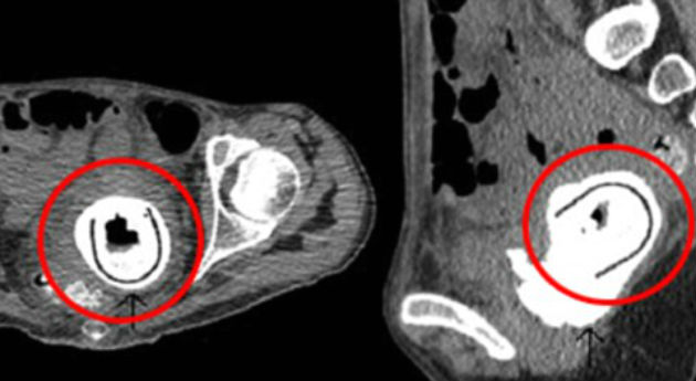 juguete sexual-radiografia