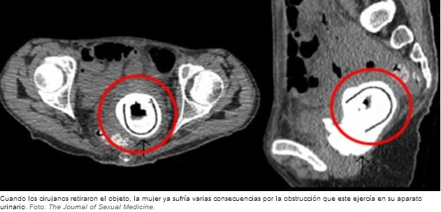 juguete sexual-radiografia