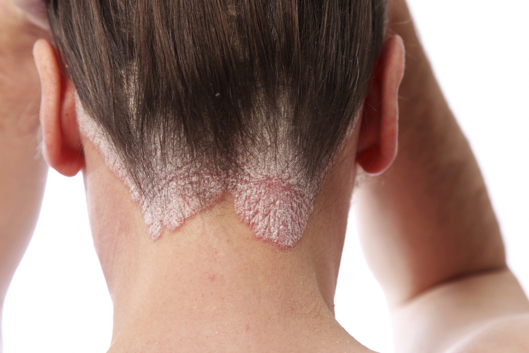 180 millones de personas padecen Psoriasis