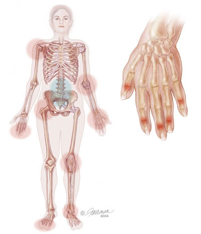 psoriatic_symptom