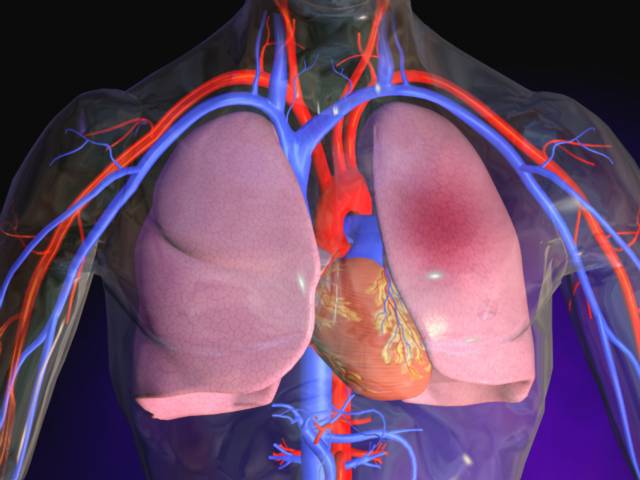 Aprobaron en Venezuela uso de nuevo fármaco para embolismo pulmonar