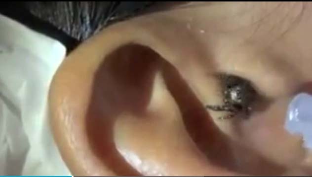 ¿Aracnofóbico? Mejor no mires a esta araña salir de una oreja (Video)