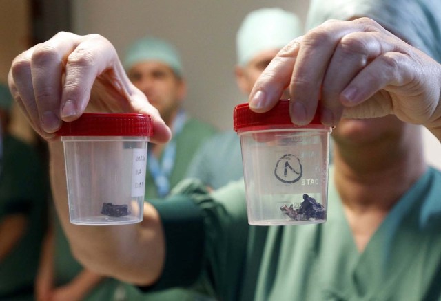 A surgeon at the Gasthuisberg hospital in Louvain, Belgium, shows shrapnel removed from victims of Tuesday's bombing attacks in Brussels following Tuesday's airport bombings in Brussels, Belgium, March 24, 2016. REUTERS/Francois lenoir