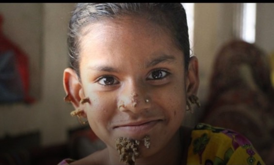 La niña que sufre la enfermedad del  hombre árbol pide ayuda (video)