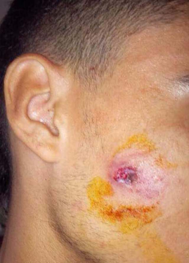El joven manifestante recibió un perdigonazo en la cara por parte de un GNB. Foto: lapatilla.1eye.us