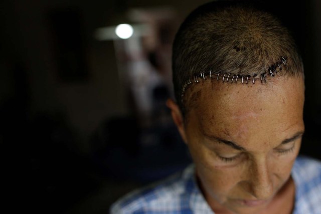 Yolyter Rodriguez, 56, a housewife and a mother-of-three, who was injured during a protest against Venezuela's President Nicolas Maduro's government, poses for a photograph at her home in Caracas, Venezuela, August 11, 2017. Rodriguez said she was struck in the face by a tear gas canister on April 23, 2017, causing skull fractures and brain damage. "I protest against hunger, for freedom and for several other reasons. But that fight is political, I'm against almost everything this government does," she said. "It's worth it. I try to see things in a positive way despite my appearance and that I'm not the same anymore. I'm a little sad and angry about that, but I'm still in the streets protesting, despite my physical condition. We cannot give up." REUTERS/Ueslei Marcelino SEARCH "VENEZUELA INJURIES" FOR THIS STORY. SEARCH "WIDER IMAGE" FOR ALL STORIES. TPX IMAGES OF THE DAY