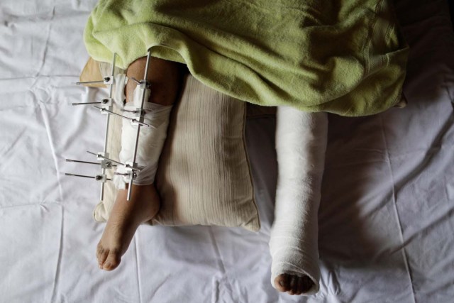 Culinary student Brian Dalati, 22, a bystander who was injured during a protest against Venezuela's President Nicolas Maduro's government, poses for a photograph inside his home in Caracas, Venezuela, August 15, 2017. Dalati said he was walking past a street barricade on his way to class during an opposition protest on July 27, 2017 when the police, mistaking him for a protester, hit him and shot him with rubber bullets in both legs. "I did not participate in the protests because I always thought it was dangerous and too violent. Today I'm in a desperate situation. I was a very active person, I enjoyed exercising, normal activities, and now I cannot do anything but sit and lie in bed all day." "I depend on my siblings to go to the bathroom, shower, brush my teeth, eat, anything. It's infuriating," he said. "They didn't have to do this. It was pure hate. Thank goodness I will be able to walk again soon." REUTERS/Ueslei Marcelino SEARCH "VENEZUELA INJURIES" FOR THIS STORY. SEARCH "WIDER IMAGE" FOR ALL STORIES.