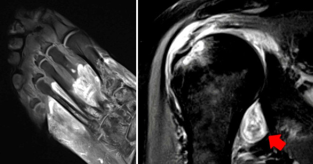 El Covid-19 puede causar gangrena, provocando que el cuerpo se ataque a sí mismo, revela un nuevo estudio