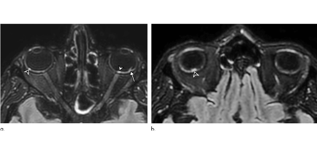 Algunos pacientes con Covid-19 salieron del hospital con nódulos en los globos oculares, revelaron investigadores franceses