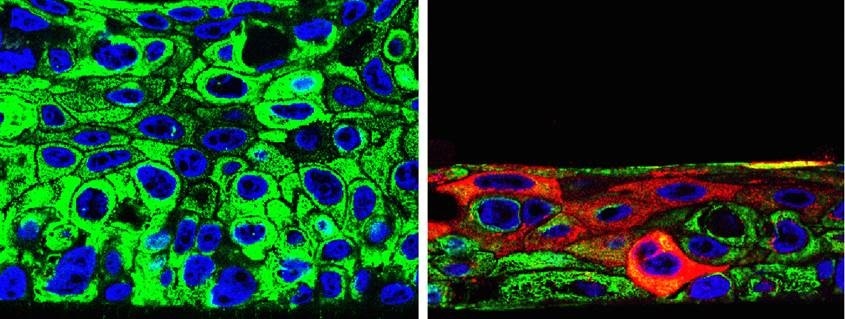 Nuevo tratamiento contra el cáncer destruyó tumores en enfermos terminales y aumentó la sobrevida