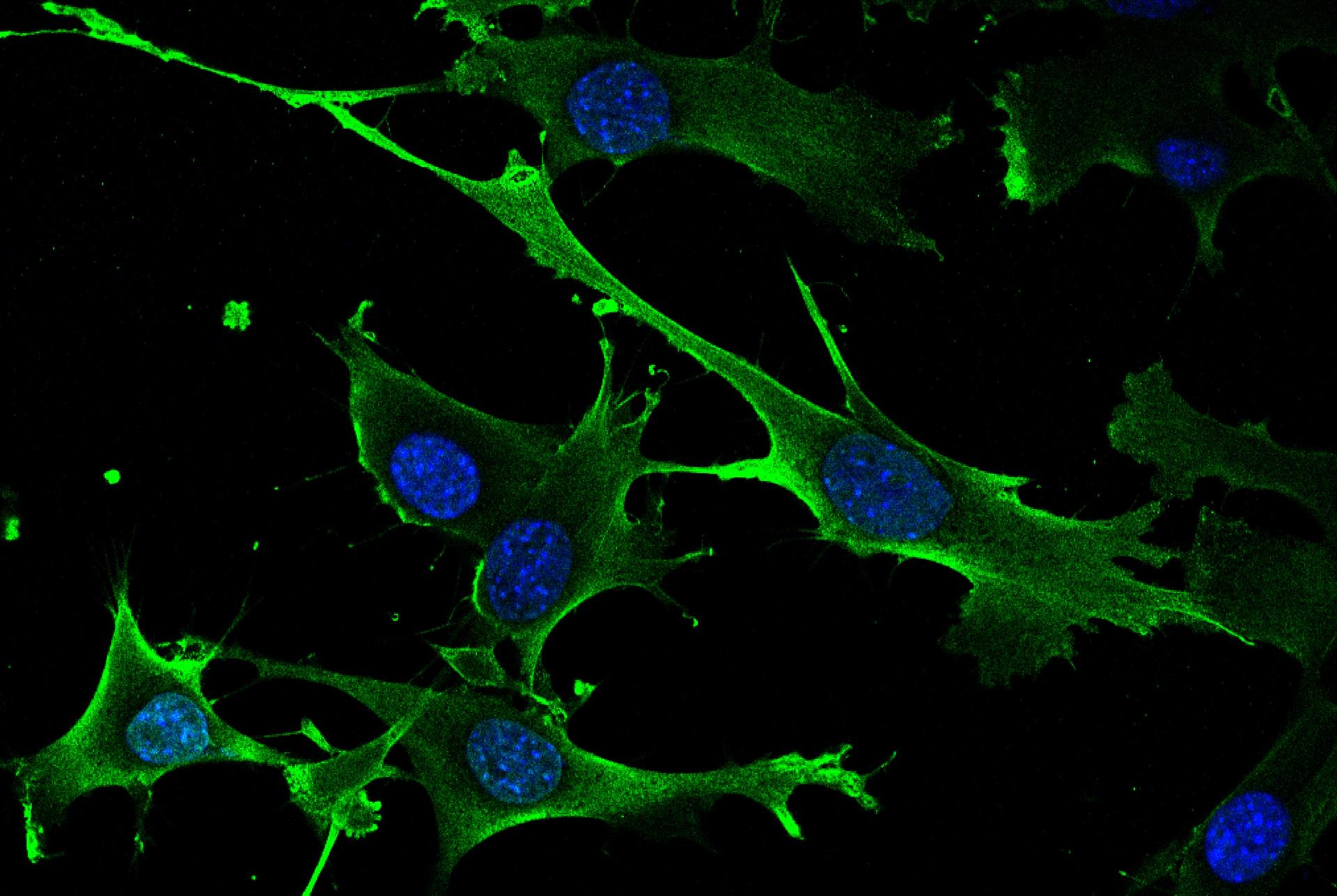 Identificado un nuevo gen inductor de cáncer y sus debilidades terapéuticas