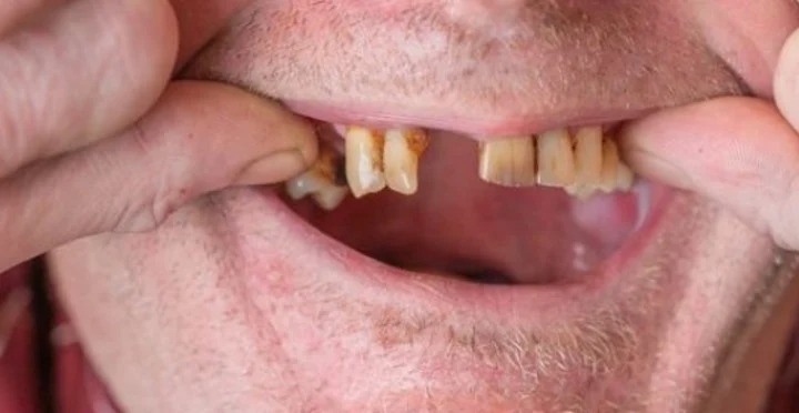 No soportaba su dolor de dientes y, al no encontrar dentistas, tomó una drástica decisión