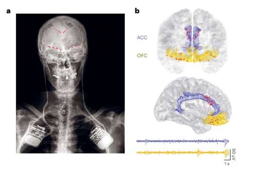 Descubren señales cerebrales que revelaría cuánto dolor siente una persona