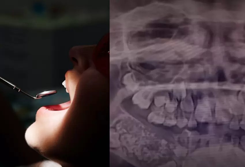 La insólita historia del niño que tenía más de 500 dientes: la mandíbula le pesaba bastante