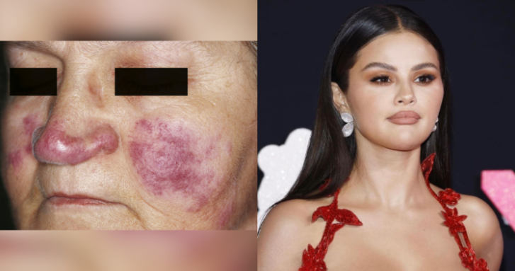 Día Mundial del Lupus: ¿en qué consiste la enfermedad autoinmune que padece Selena Gómez?