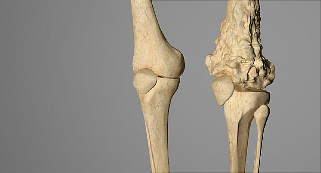 Científicos desvelaron los factores que impulsan el osteosarcoma, un cáncer óseo agresivo